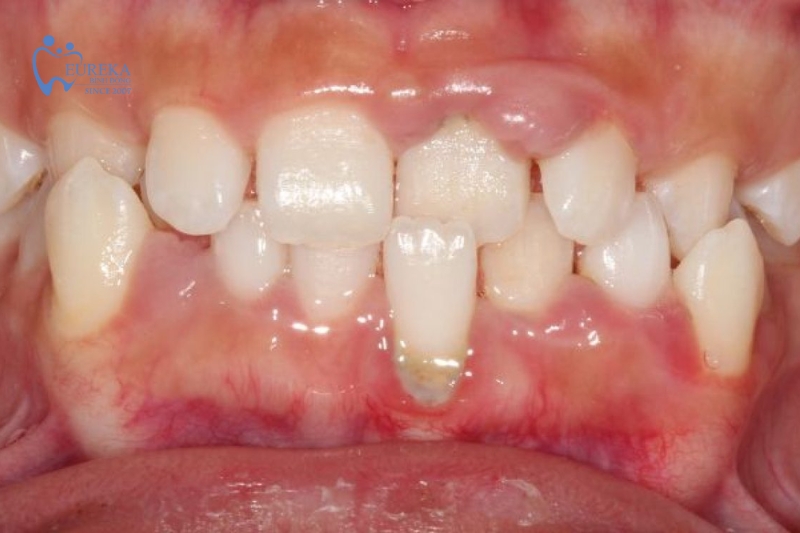 Cách phòng ngừa hiện tượng tụt nướu răng