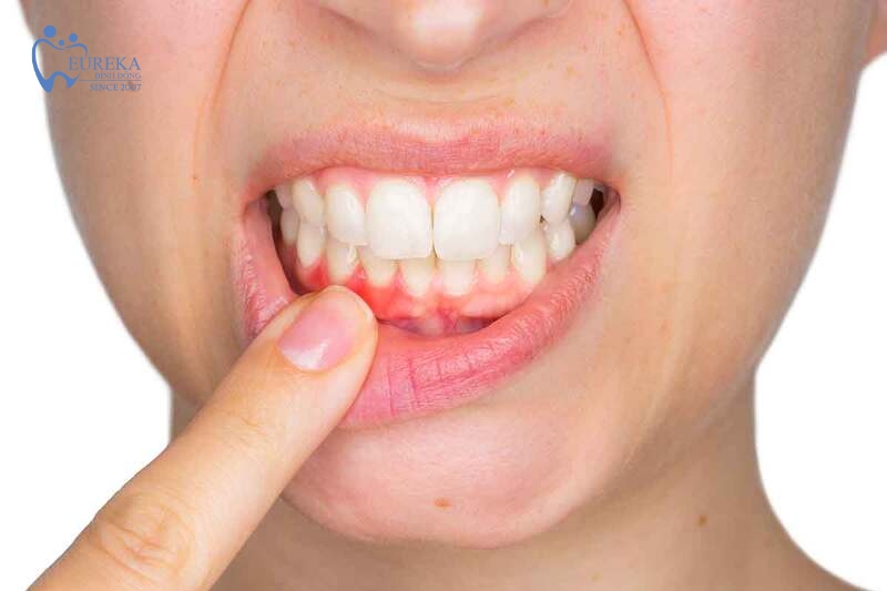 Hiện tượng tụt nướu răng là gì?
