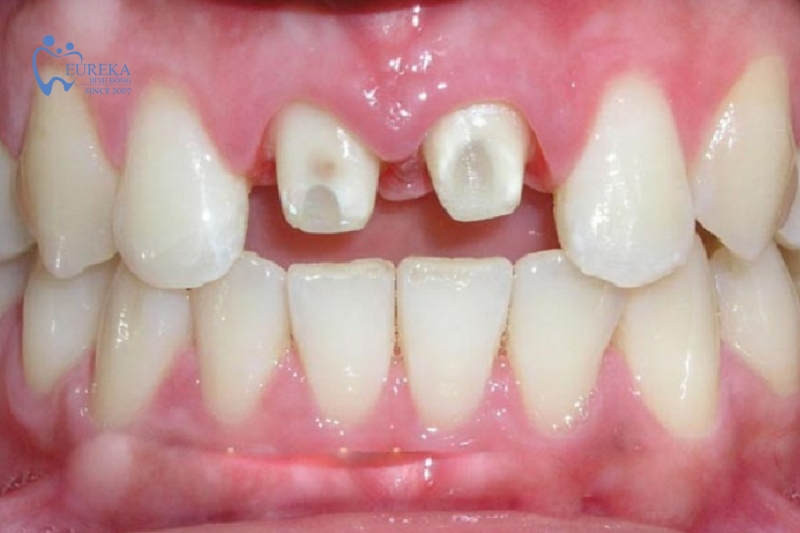 Những thực phẩm tốt cho sức khỏe nướu răng