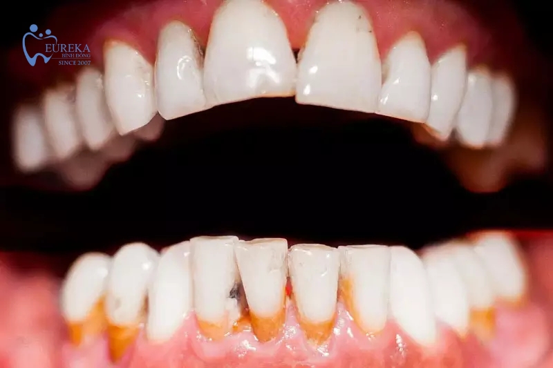 Tụt nướu răng gây thoái hóa xương hàm