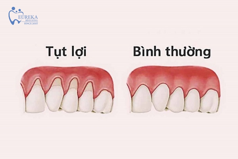 Tụt nướu răng gây các bệnh lý toàn cơ thể