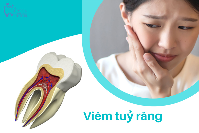 Khi Nào Cần Điều Trị Tủy Răng?