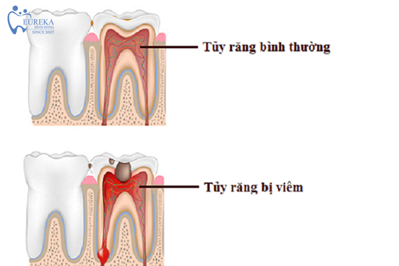 Tuỷ răng khi vị viêm và tuỷ răng khi bình thường