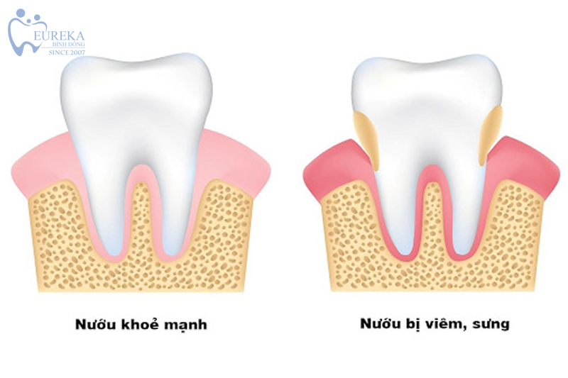 Viêm nhiên tủy răng là gì?