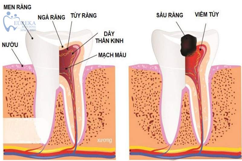 Triệu chứng của viêm nhiễm tủy răng