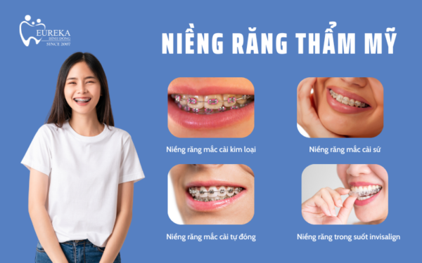 Niềng răng thẩm mỹ tại nha khoa Eureka