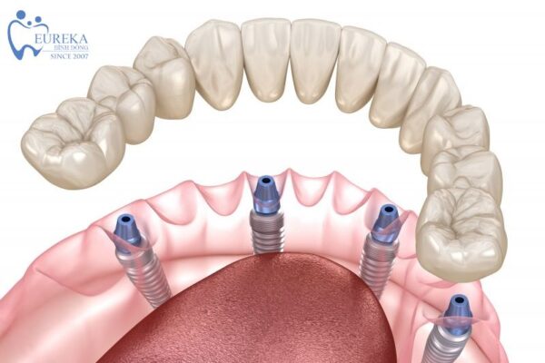 Cấy ghép implant on all 4 là gì?