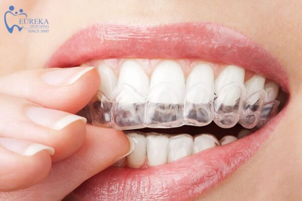 Niềng răng trong suốt Invisalign