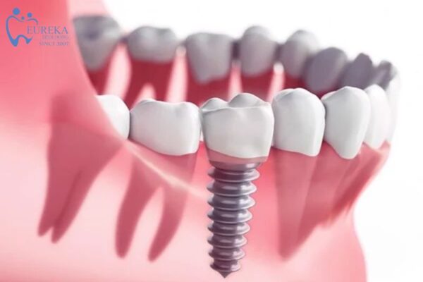 Thời gian trồng răng implant hết bao lâu?