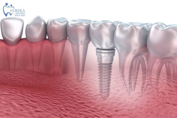 Nha khoa Eureka Bình Đông cung cấp dịch vụ cấy ghép implant