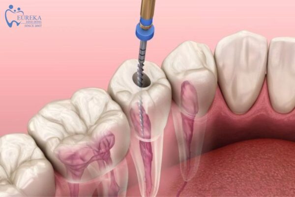 Điều trị nội nha