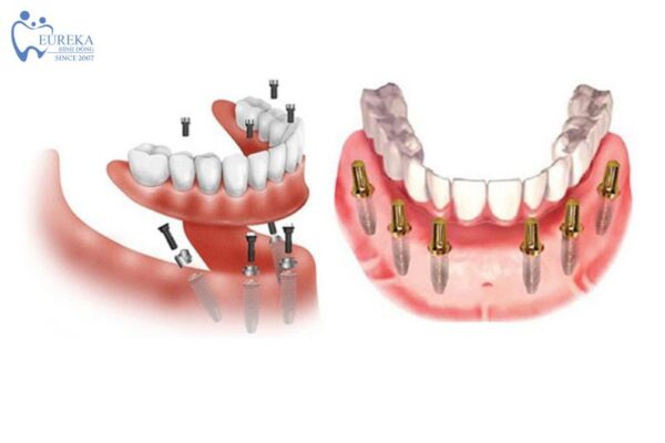 Các thủ tục cần thiết trước khi cấy ghép All on X