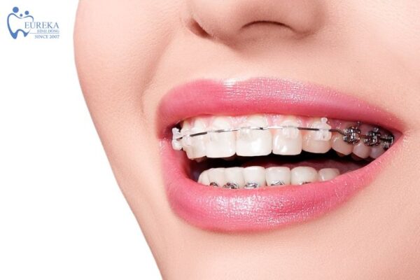 Kỹ thuật niềng răng tại nha khoa Eureka Bình Đông