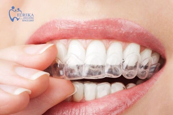 Niềng răng 3D - Công nghệ niềng răng hiện đại