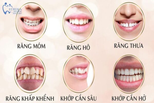 Lý do việc niềng răng ngày càng được ưa chuộng