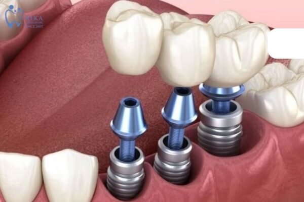 Lợi ích chính của cấy ghép implant mà bạn nên biết.