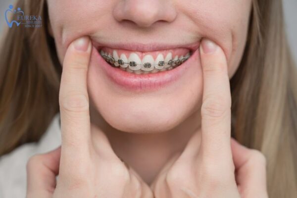 Niềng răng mắc cài kim loại có tầm quan trọng và lợi ích rất lớn