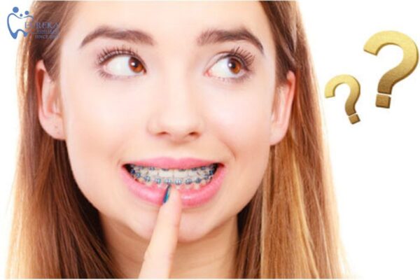 Những tác động của niềng răng mắc cài kim loại đến ăn uống