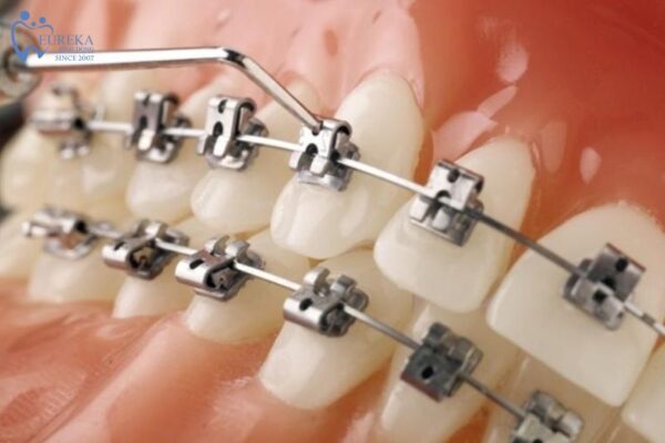 Lợi ích và hạn chế của niềng răng mắc cài kim loại