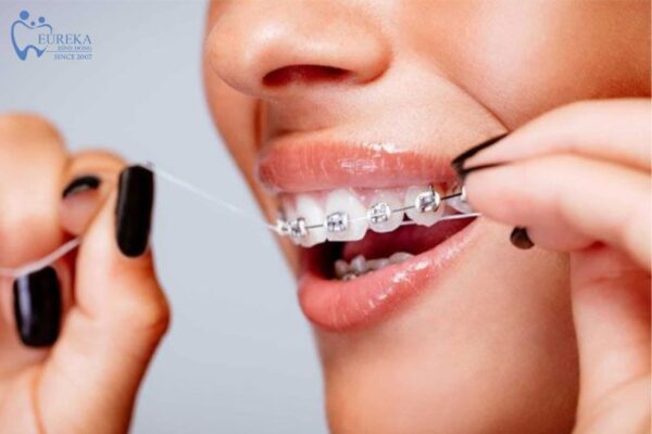 Tại sao phải chăm sóc và vệ sinh niềng răng