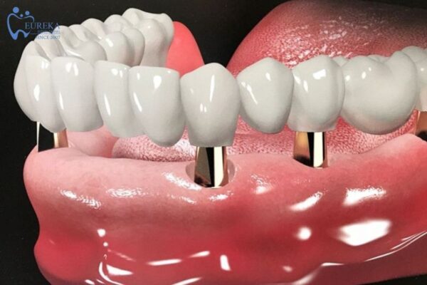 Cách chọn địa chỉ cấy ghép implant uy tín