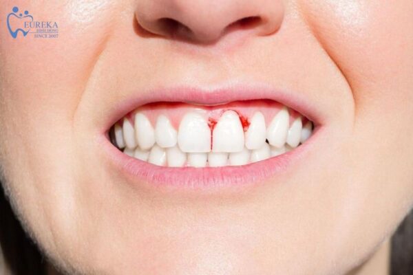 Nguyên nhân gây ra viêm lợi