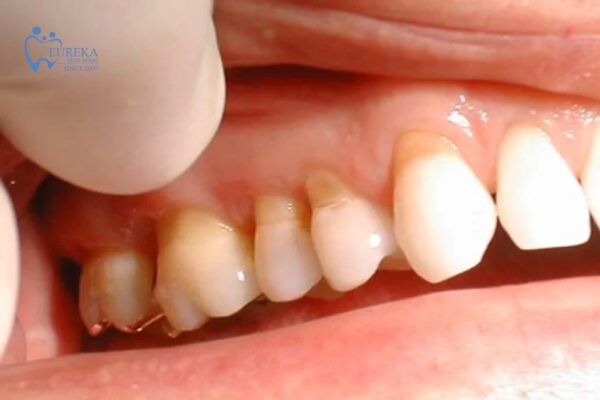 Những cách trị tụt nướu phổ biến hiện nay