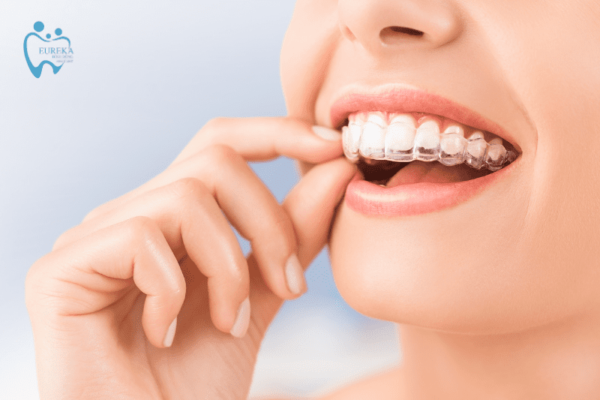 Niềng răng trong suốt Invisalign và những điều cần biết