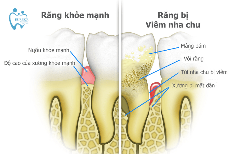 Nguyên nhân mắc phải bệnh viêm nha chu là gì?