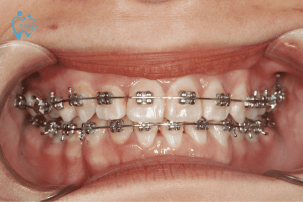 Niềng răng là gì? Các lợi ích khi niềng răng