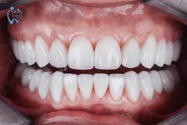 Quy trình làm răng sứ diễn ra như thế nào?