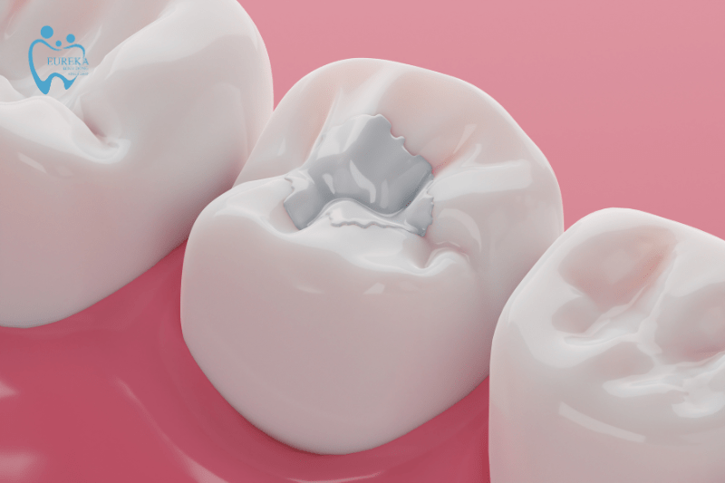 Các trường hợp nên thực hiện trám răng