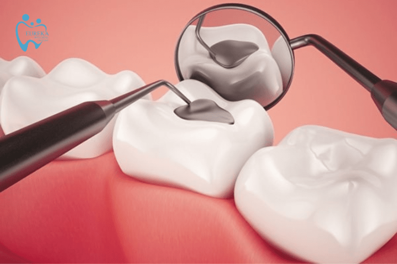 Những điều bạn cần biết về dịch vụ trám răng