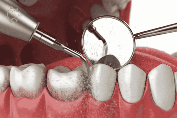 Cạo vôi răng có đau không, có ê buốt không?