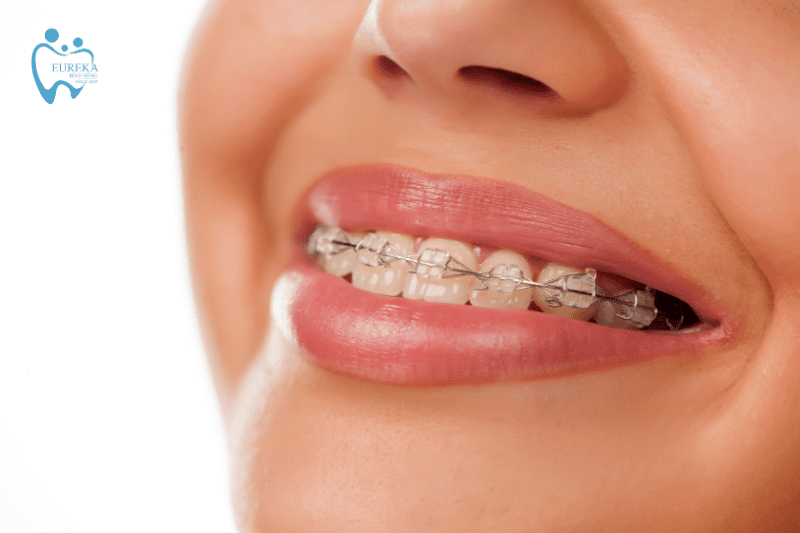 Chỉnh nha là gì? Trường hợp cần áp dụng biện pháp chỉnh nha