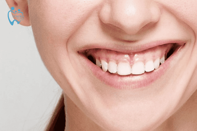 Cười hở lợi là gì? Phương pháp cải thiện nụ cười hở lợi