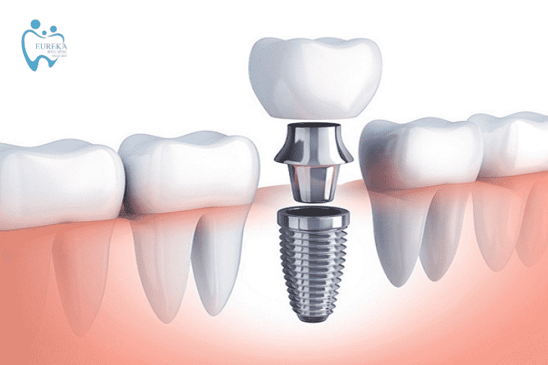 Cấy ghép Implant có tốt không?