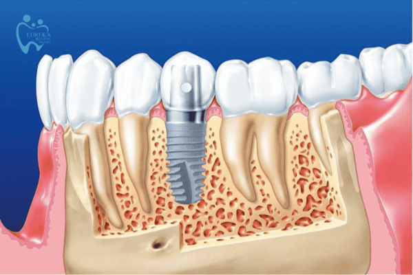 Trồng răng Implant - Giải pháp tối ưu cho người mất răng