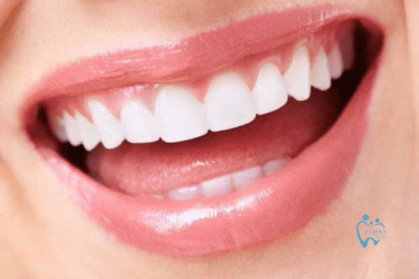 Một số vấn đề về răng cửa thường gặp