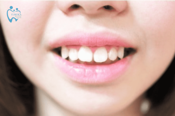 Răng hô là gì? Các phương pháp điều trị răng hô hiệu quả