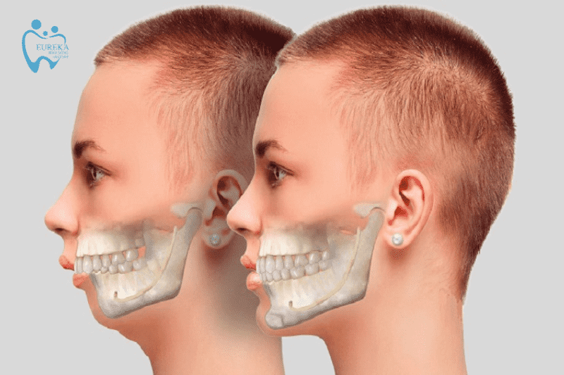 Phương pháp điều trị răng hô