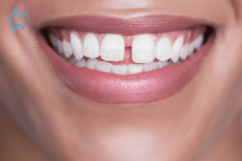 Vì sao răng thưa, răng thưa ảnh hưởng thế nào đến sức khỏe?