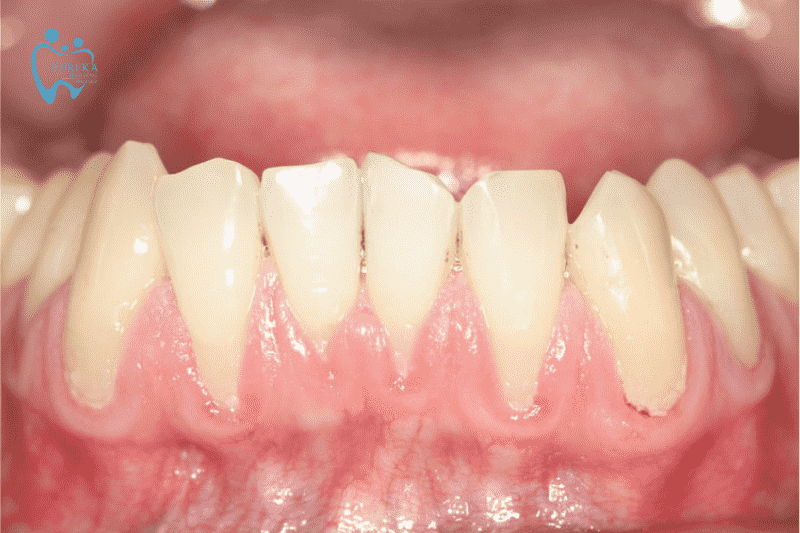 Tụt nướu răng ảnh hưởng thế nào đến sức khỏe răng miệng?