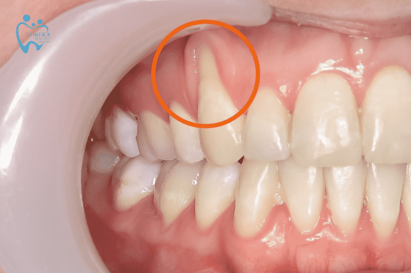 Biểu hiện của tụt nướu răng là gì?