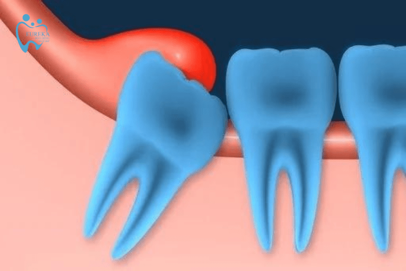 Triệu chứng viêm lợi trùm
