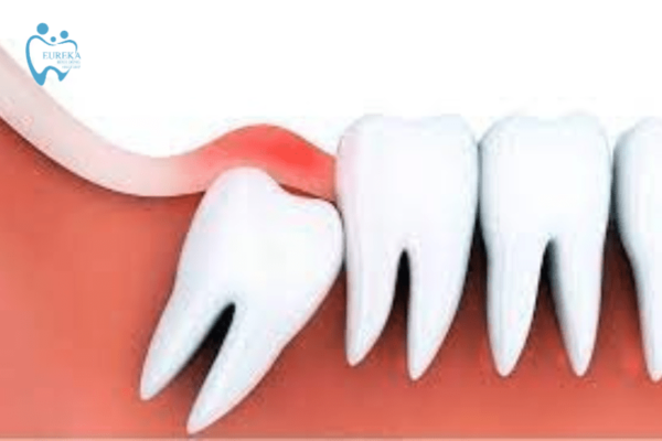 Các biến chứng cực kỳ nguy hiểm của bệnh lý viêm lợi trùm